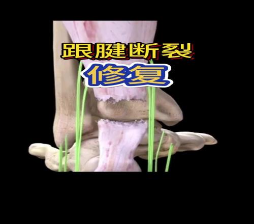 看着都疼啊!科普帖:球员脚跟腱断裂是如何进行修复的