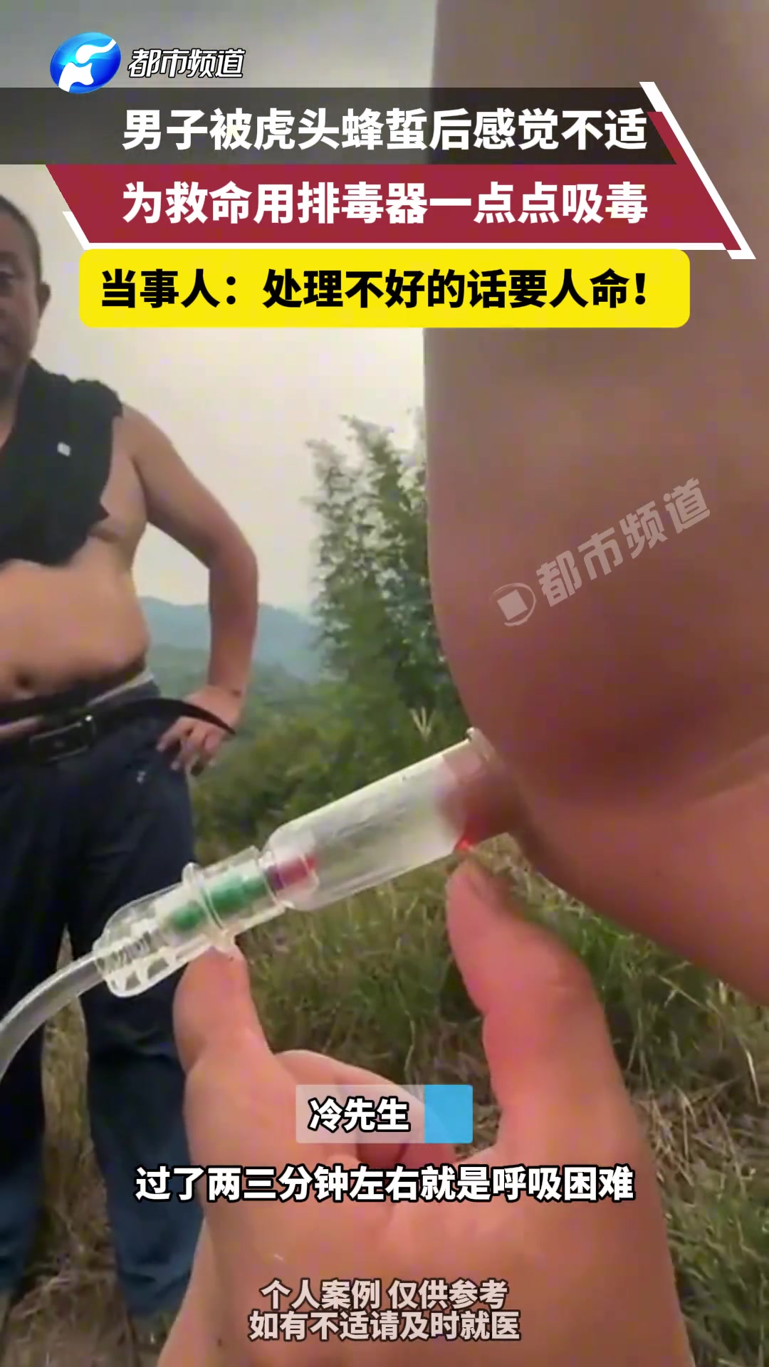 为救命用排毒器一点点吸毒!男子被虎头蜂蜇后感觉不适!可太毒了