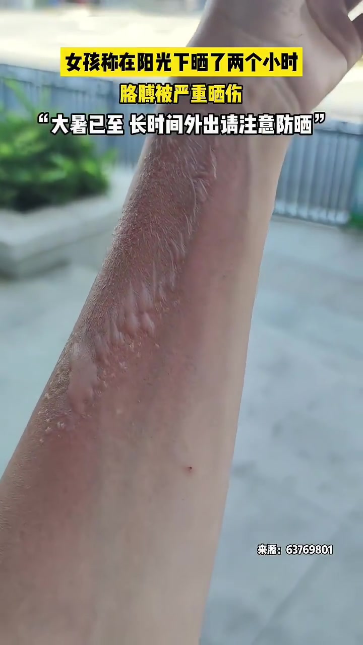 女孩称在阳光下晒了两个小时,胳膊被严重晒伤!