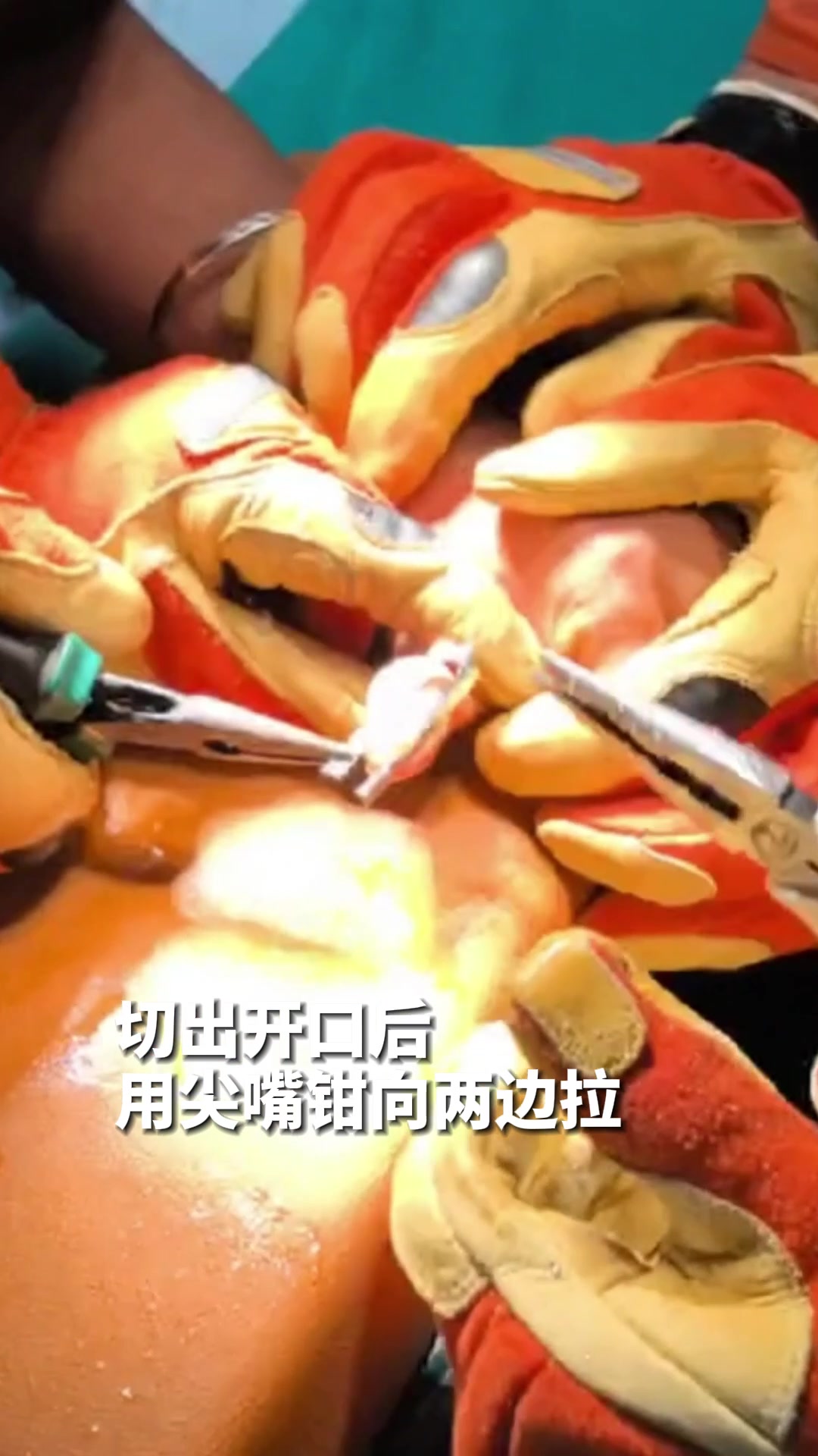 女子拇指塞刀刃缝!消防手术式救援