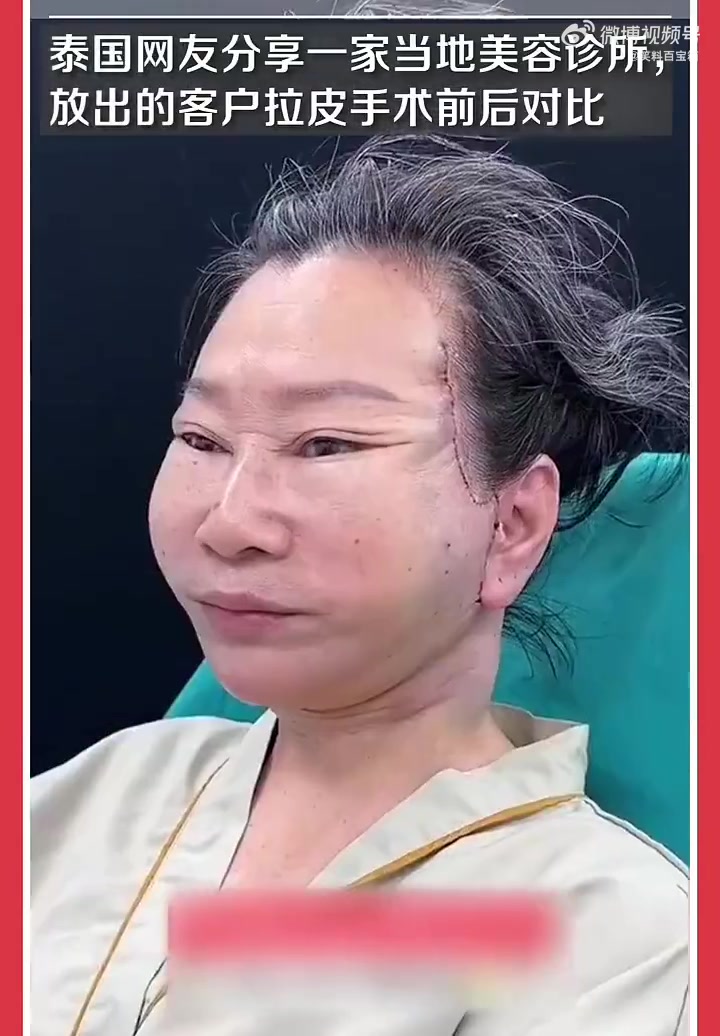泰国一家美容诊所放客户拉皮手术前后对比图，灵魂像被拉出窍