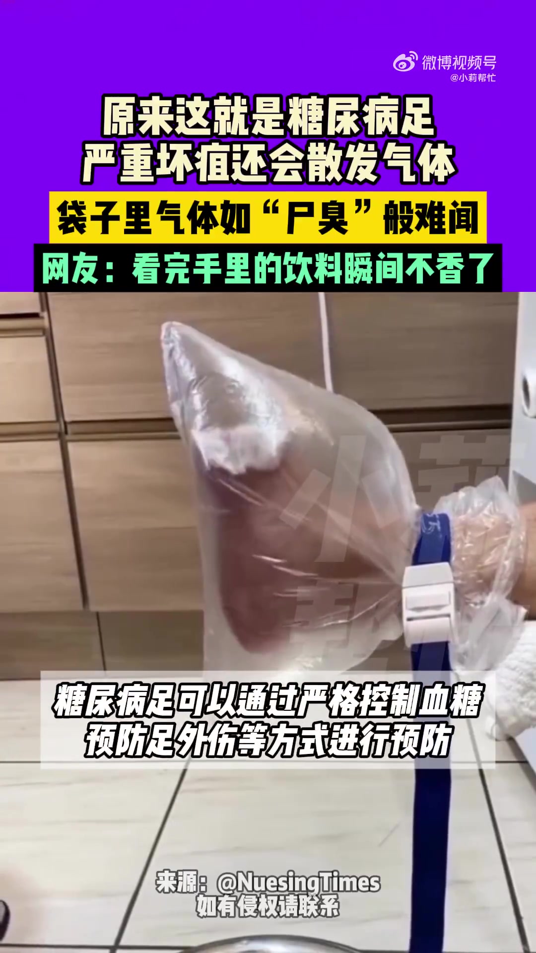 10月30日发布，糖尿病足严重坏疽会散发难闻气体
