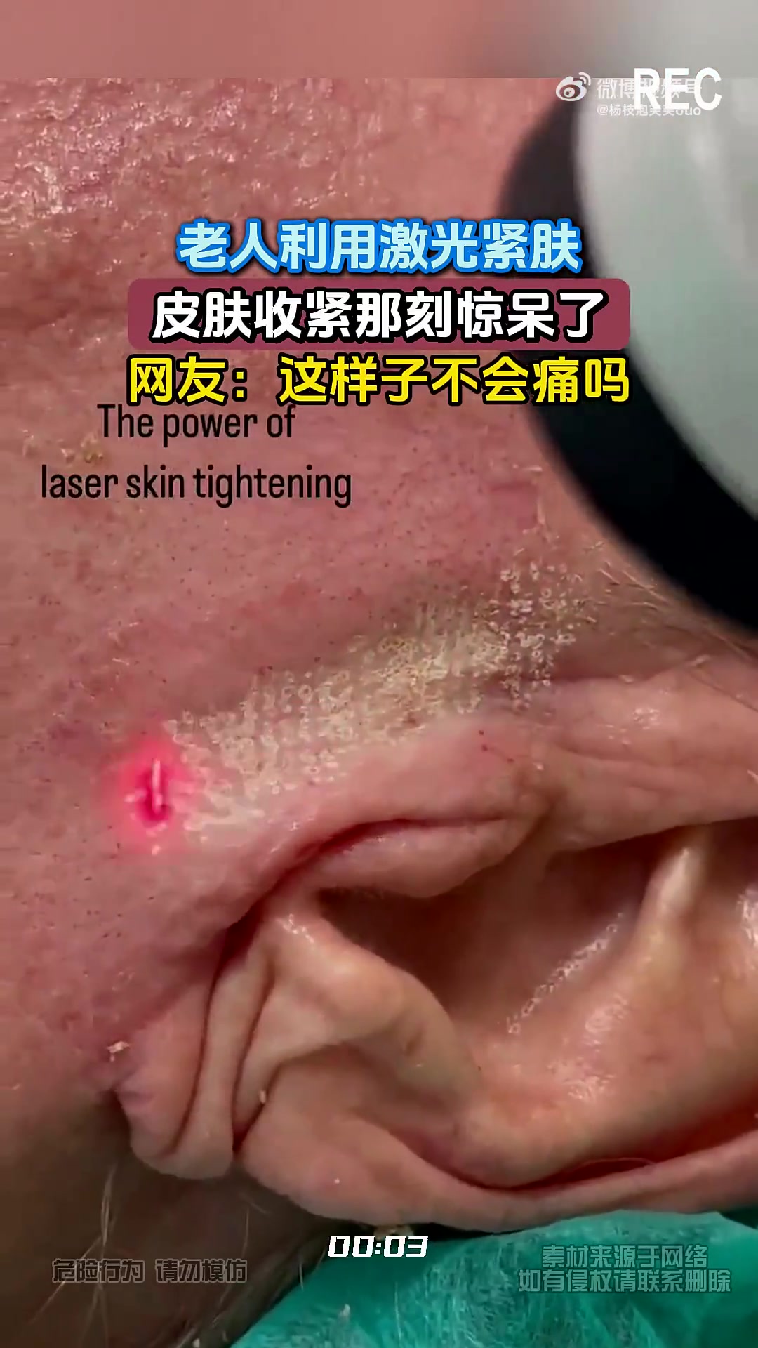 老人利用激光紧肤，皮肤收紧那刻惊呆了，网友：这样子不会痛吗