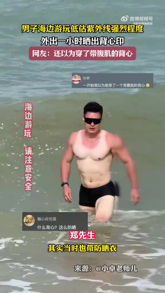 肌肉男海边游玩低估紫外线强烈程度，外出一小时晒出背心印！