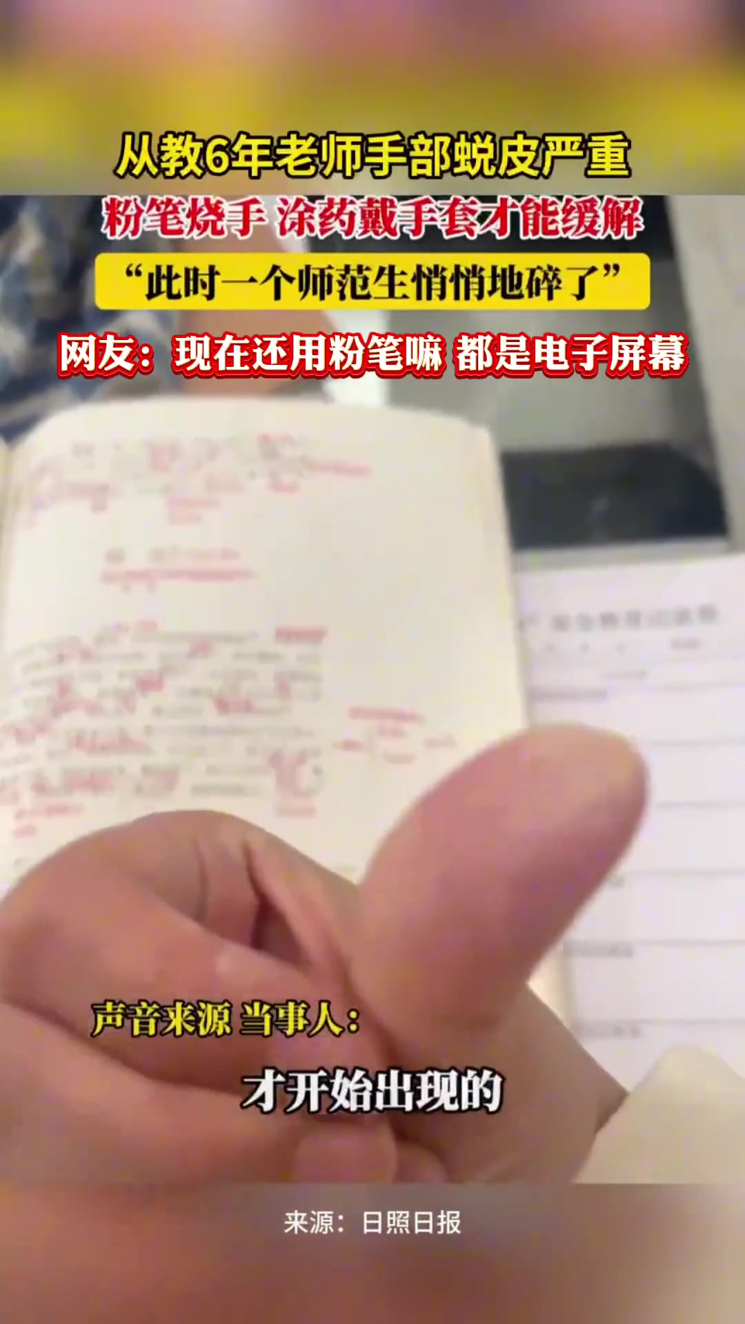 致敬！从教6年的老师手部蜕皮严重，粉笔烧手！