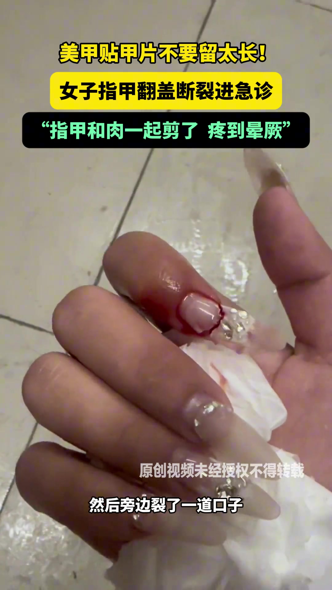女子指甲翻盖断裂进急诊“指甲和肉一起剪了直接疼到晕厥”