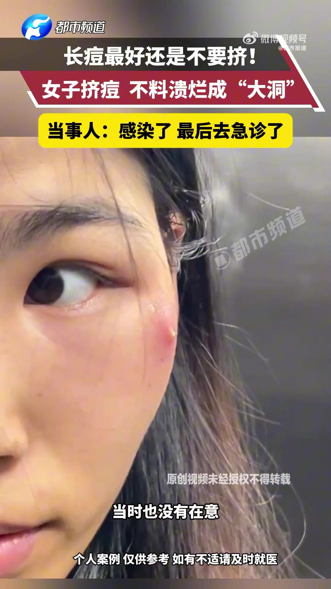 女子挤痘溃烂成大洞感染进急诊