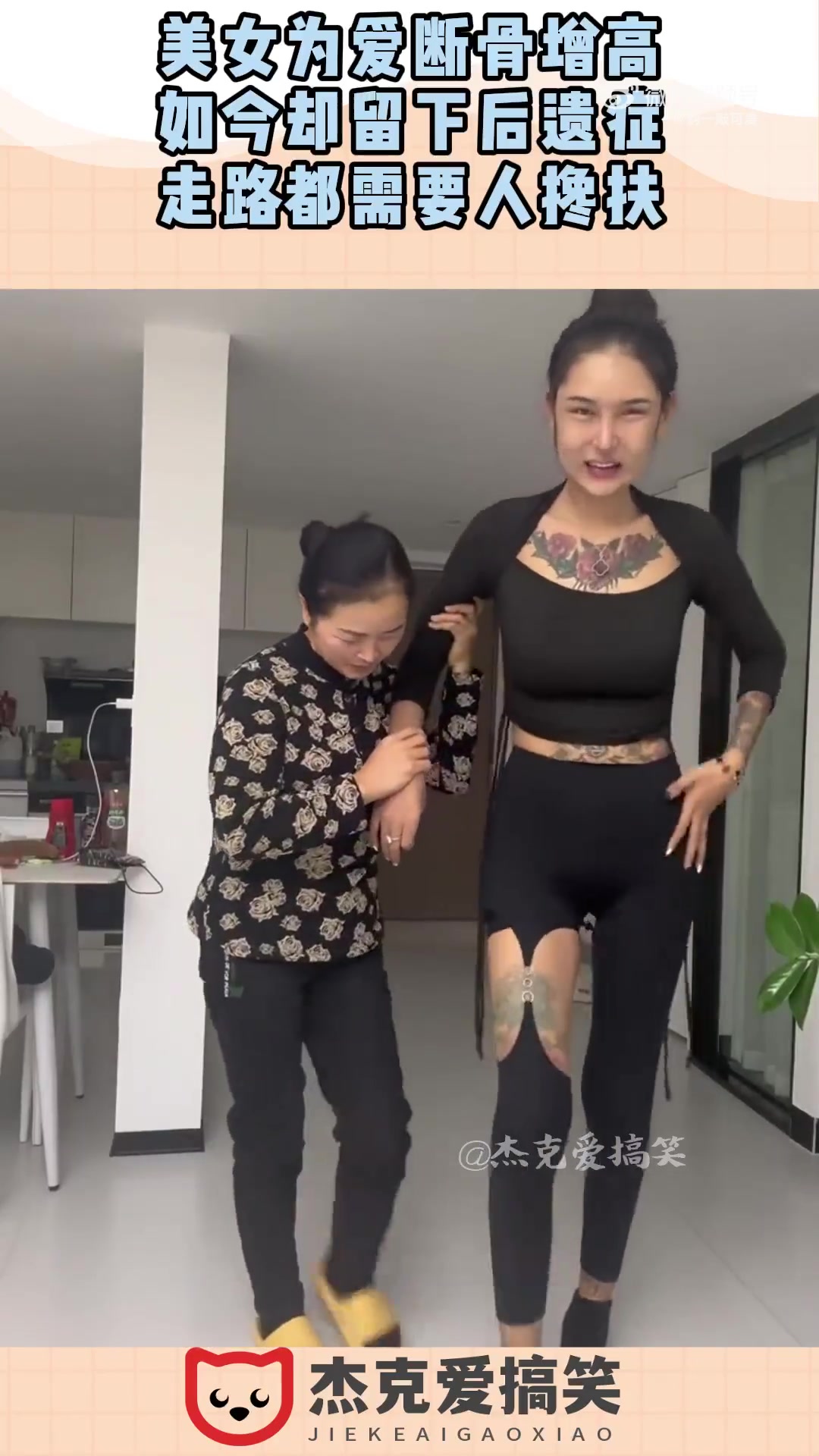 美女为爱断骨增高，如今却留下后遗症，走路都需要人搀扶！！！