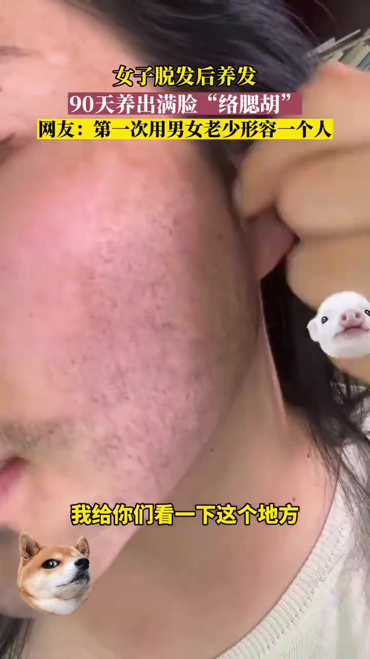 女子脱发后积极养发，90天后竟长出满脸“络腮胡”