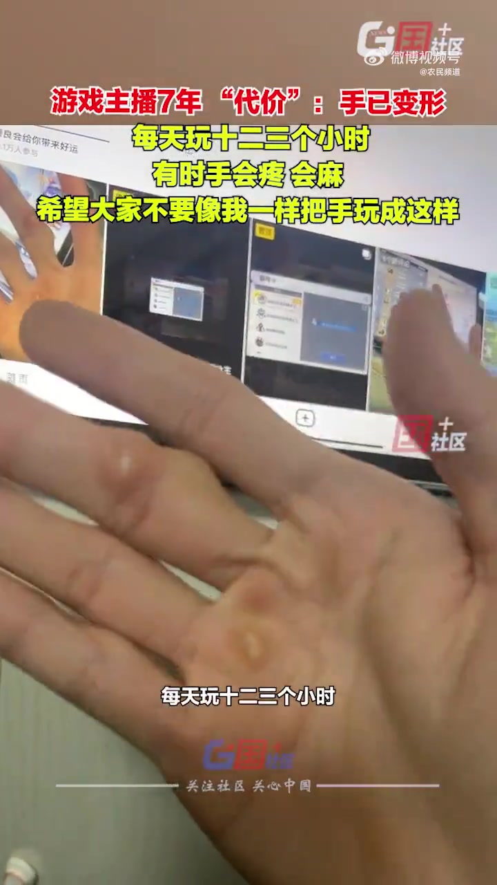 男子做游戏主播7年手指严重变形每天玩十二三个小时
