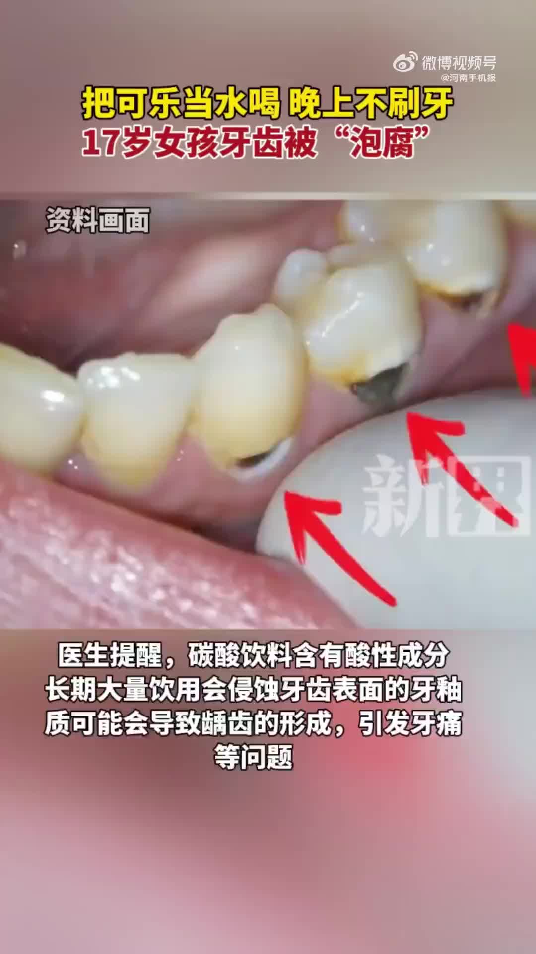 17岁女孩一天5瓶可乐，晚上不刷牙，牙齿被泡腐