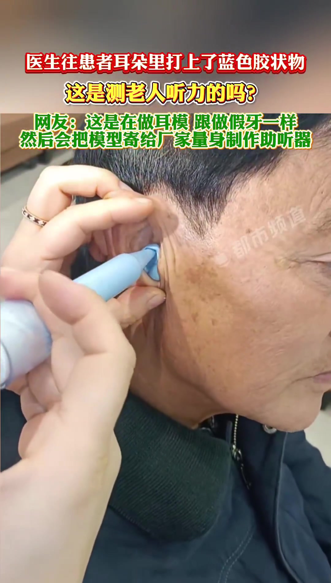 医生往患者耳朵里打上了蓝色胶状物，这会粘耳屎吗