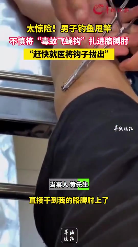 男子钓鱼甩竿，不慎将“毒蚊飞蝇钩”扎进胳膊肘