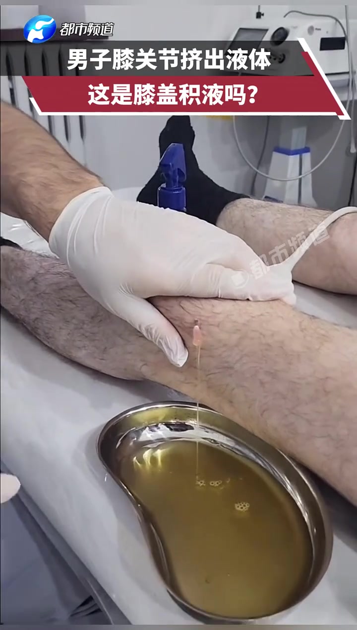 男子膝关节挤出液体，这是膝盖积液吗