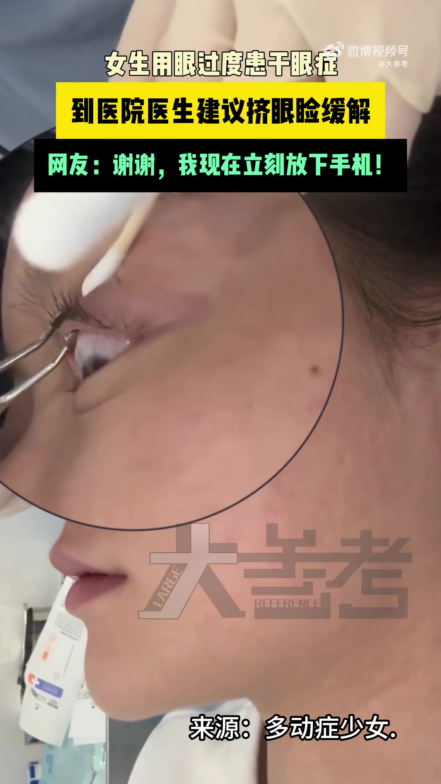 医生挤眼睑帮女子缓解干眼症