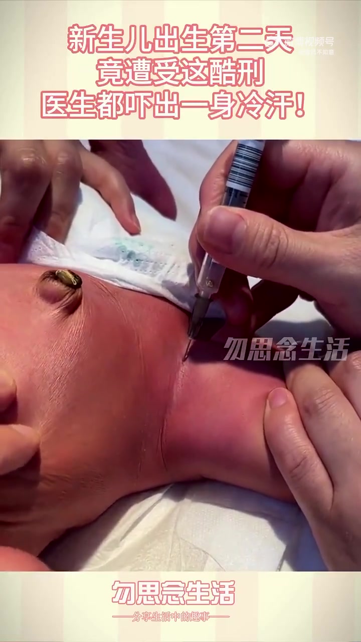 新生儿出生第二天，竟遭受这酷刑，医生都吓出一身冷汗！！！！！