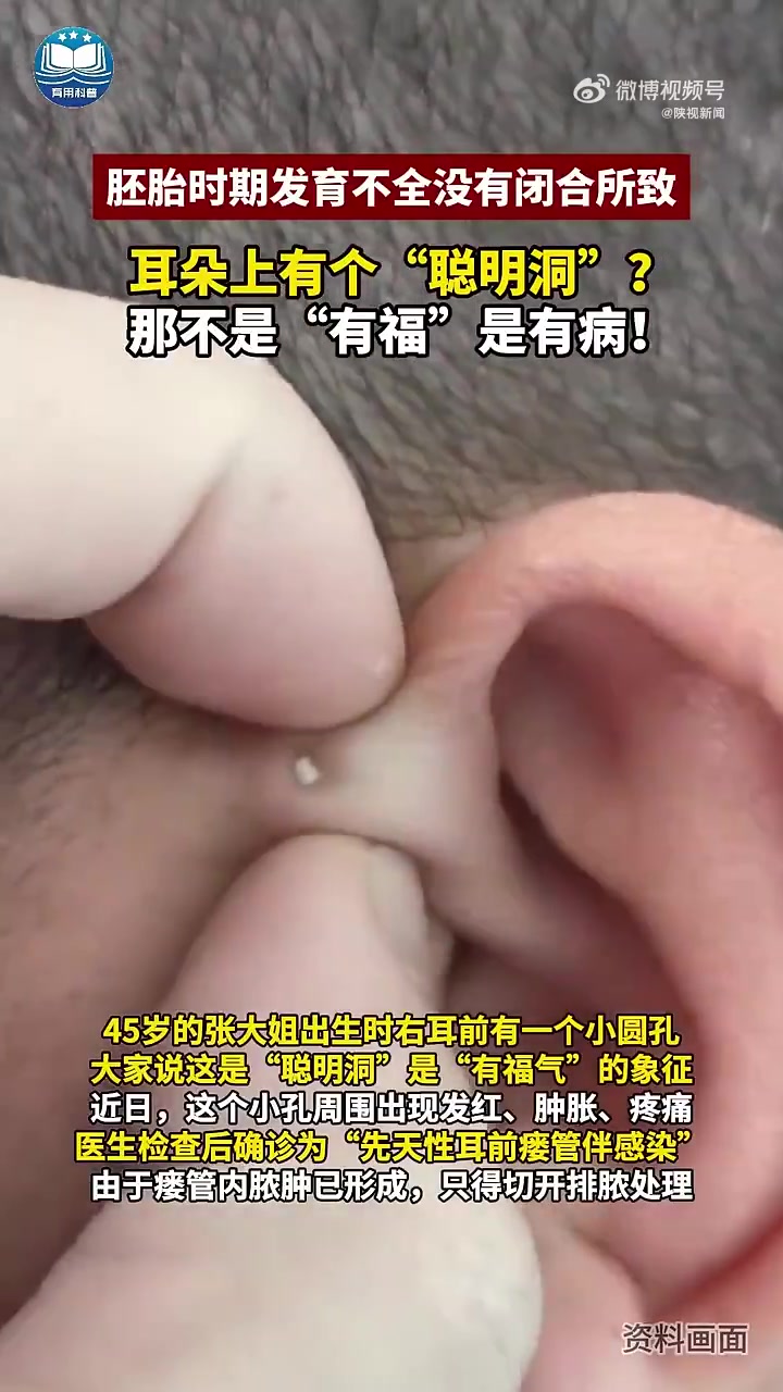 耳朵上的聪明洞原来是胚胎发育不全