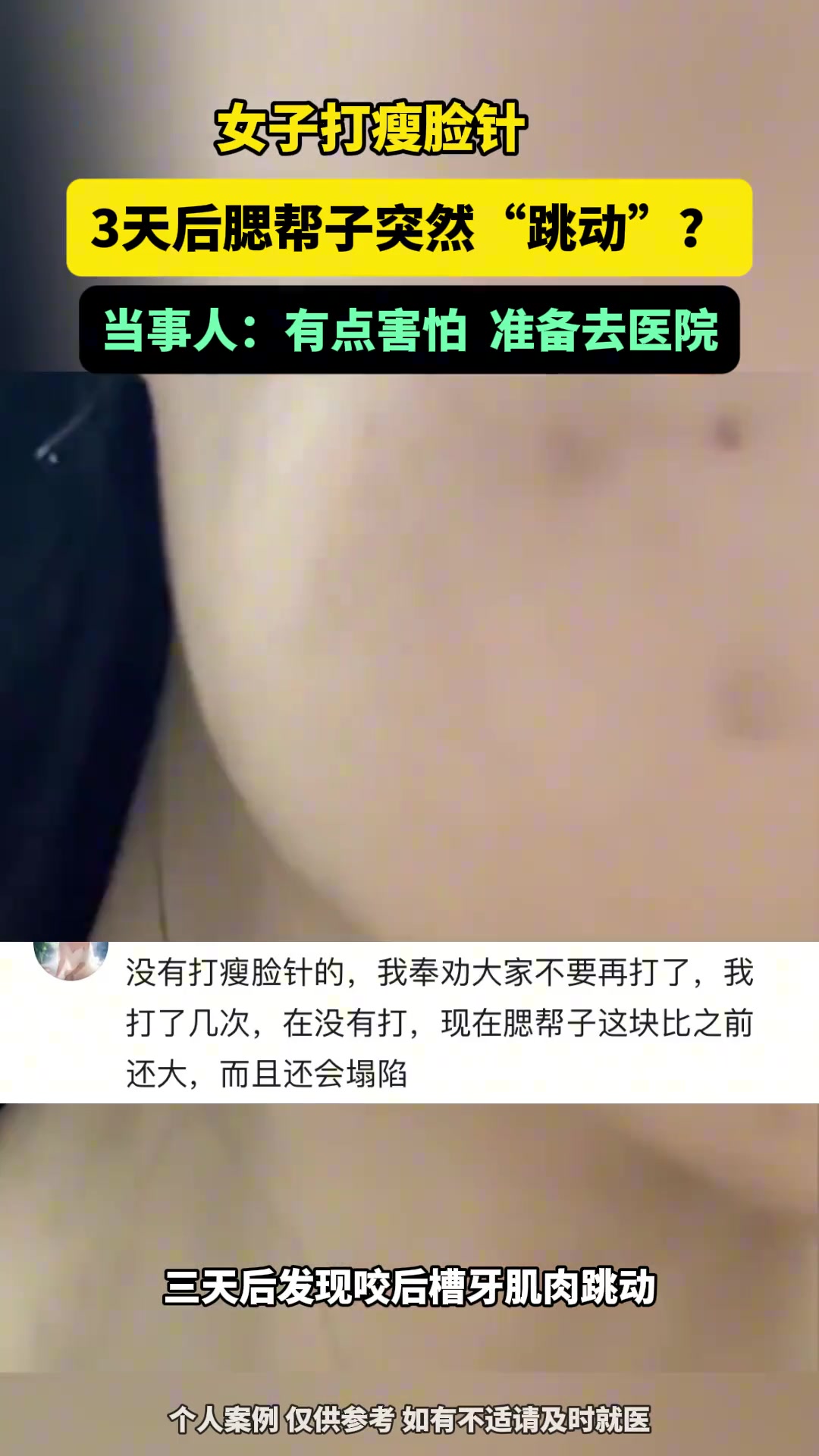 吓人！女子打瘦脸针3天后腮帮子突然“跳动”