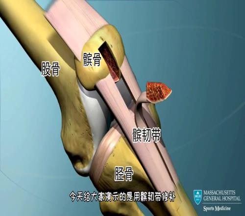 大罗经历的手术，膝关节十字韧带修复手术，希望卡瓦哈尔早日康复