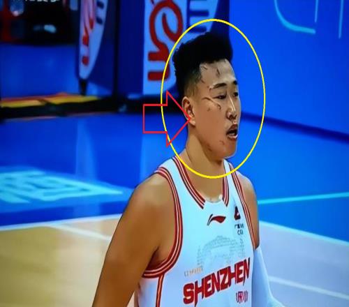 触目惊心！打了一场CBA比赛，整张脸都被“毁容”了球迷：可怕