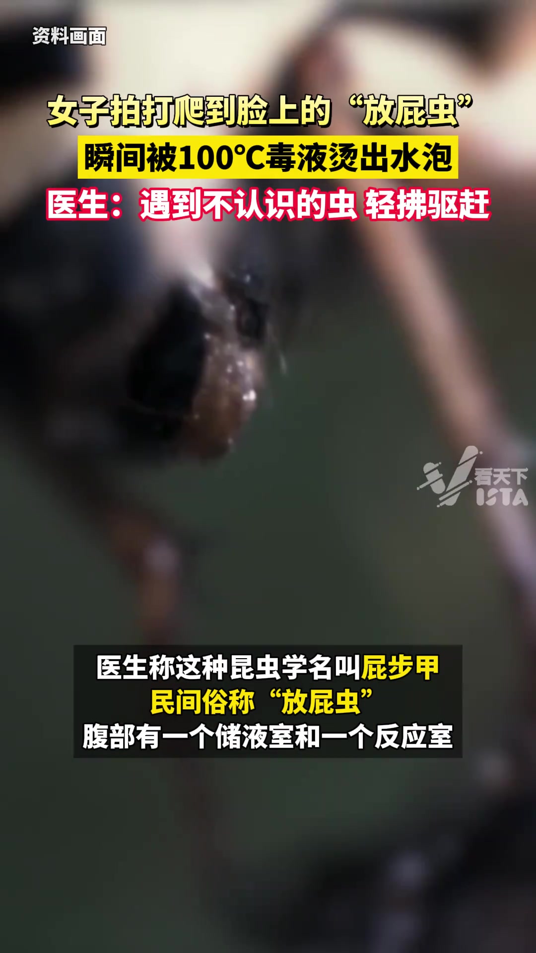 女子拍打爬到脸上的放屁虫，瞬间被100℃毒液烫出水泡