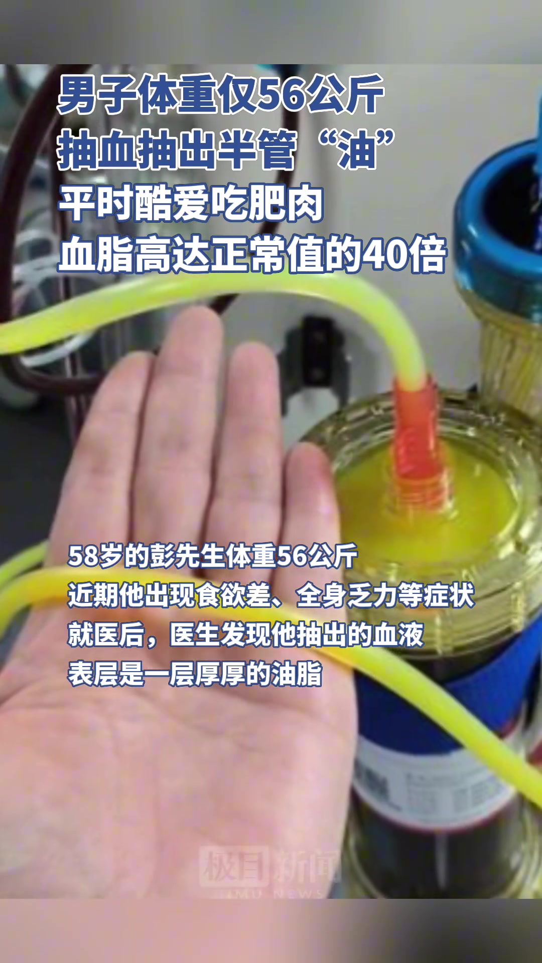 56公斤男子抽血抽出半管“油”？血脂高达正常值40倍