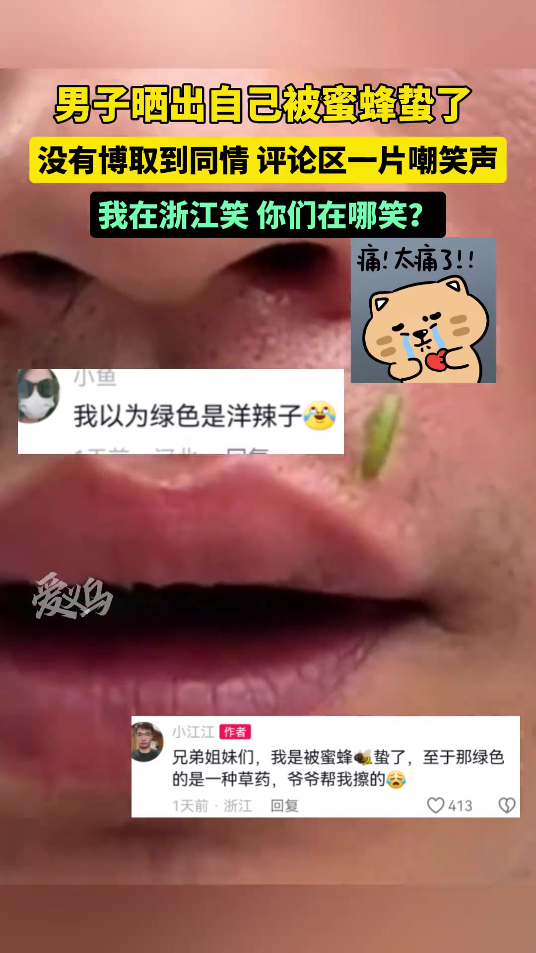 男子晒出自己被蜜蜂蛰了，没有博取到同情而是一片笑声