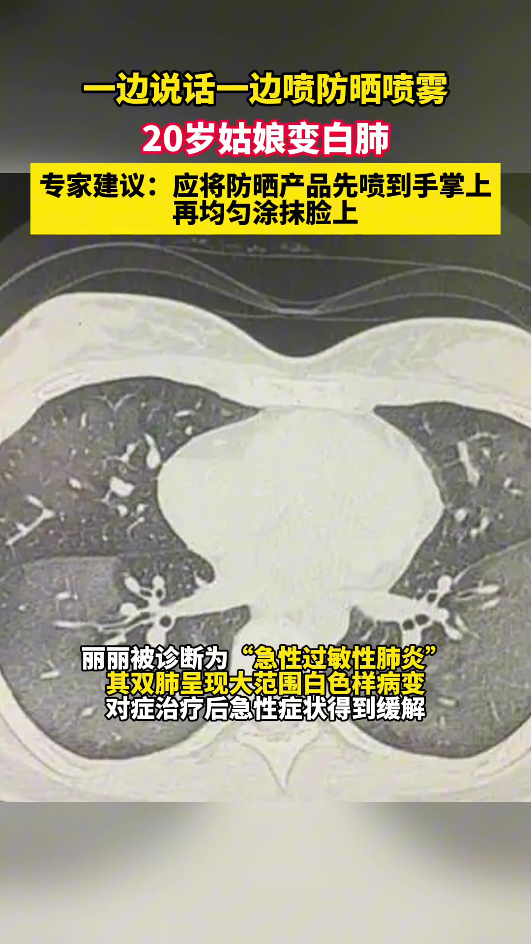 防晒喷雾可能导致白肺？