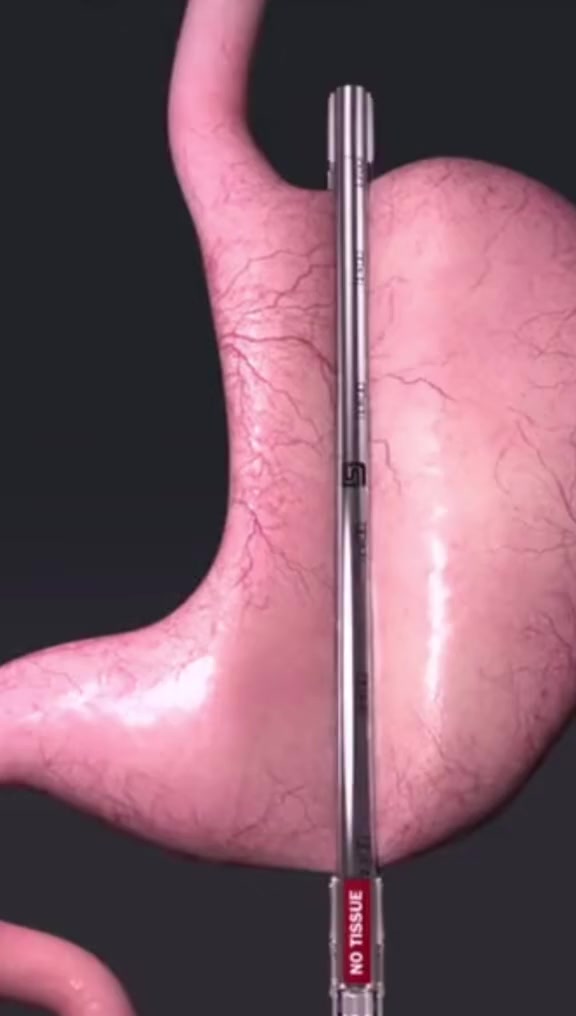 切胃减肥模拟，看完你还想靠这种方式减肥吗？