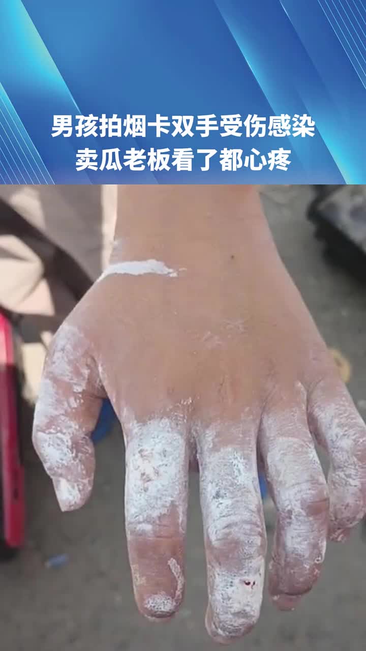男孩拍烟卡拍到双手受伤感染这么瘾的吗