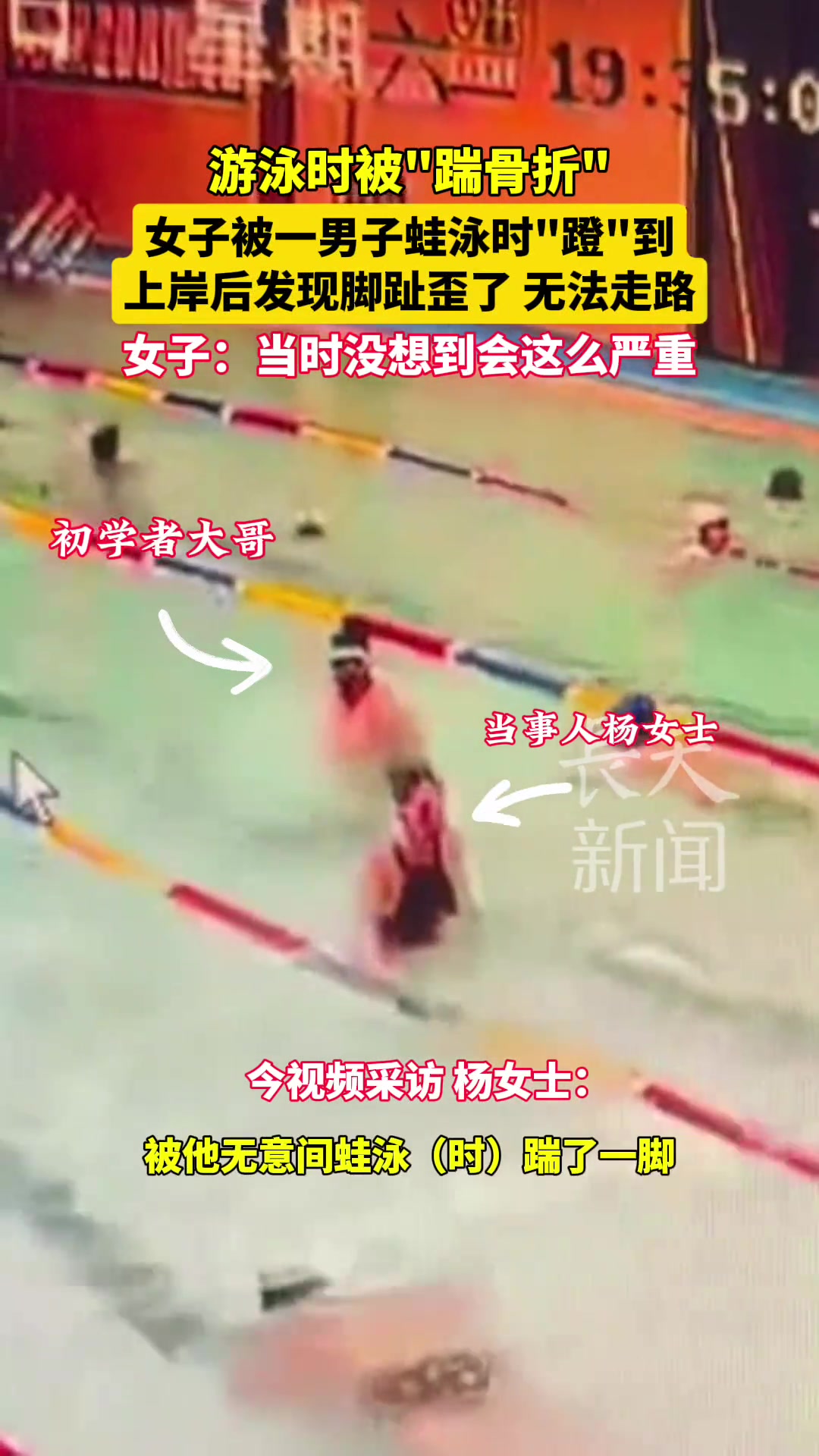 女子被一男子蛙泳时“蹬”到上岸后到医院看了发现是骨折了