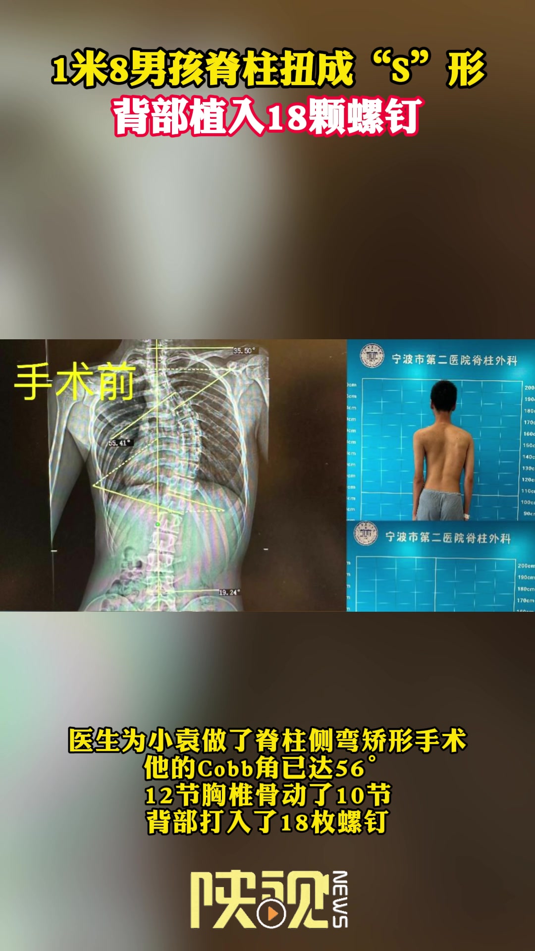 1米8男孩脊柱扭成“S形”背部植入18颗钢钉