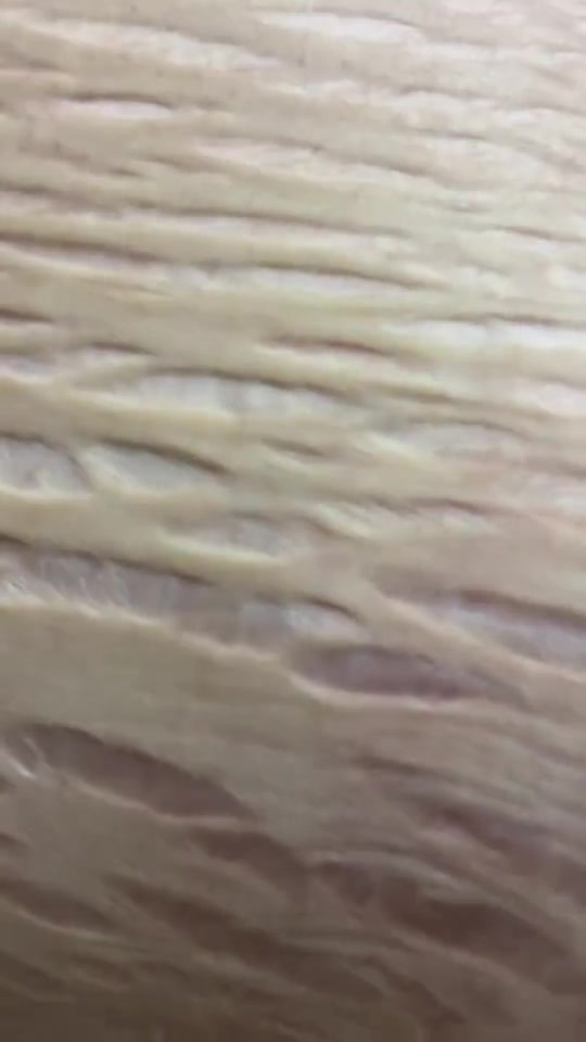 放大50倍看妊娠纹！母亲太不容易！