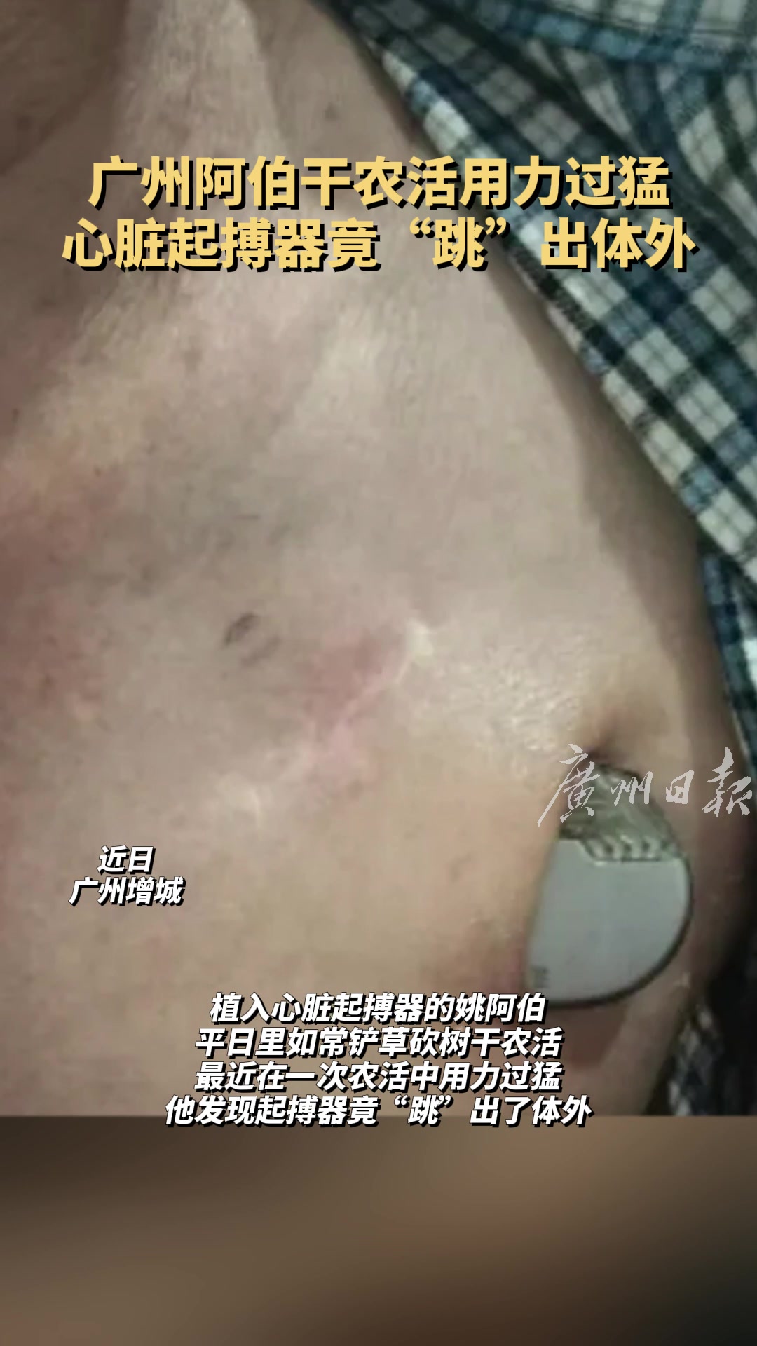 老农干活太猛致心脏起搏器跳出体外！