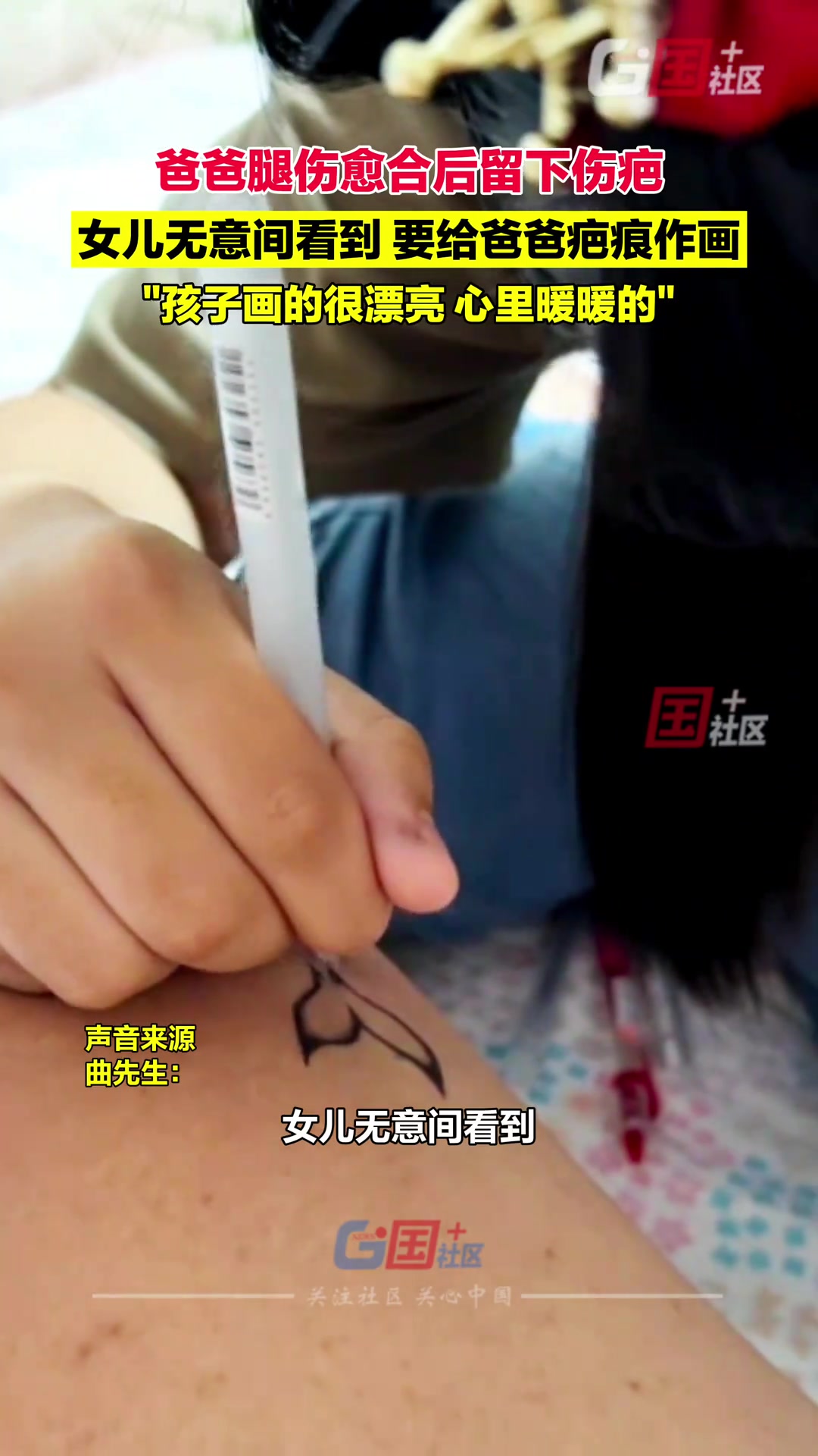 宝爸腿伤愈合后留下伤疤女儿无意间看到要为爸爸的疤痕作画