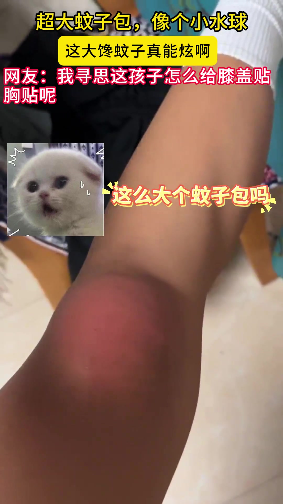 这是被蚊子国王咬的挺别致啊！