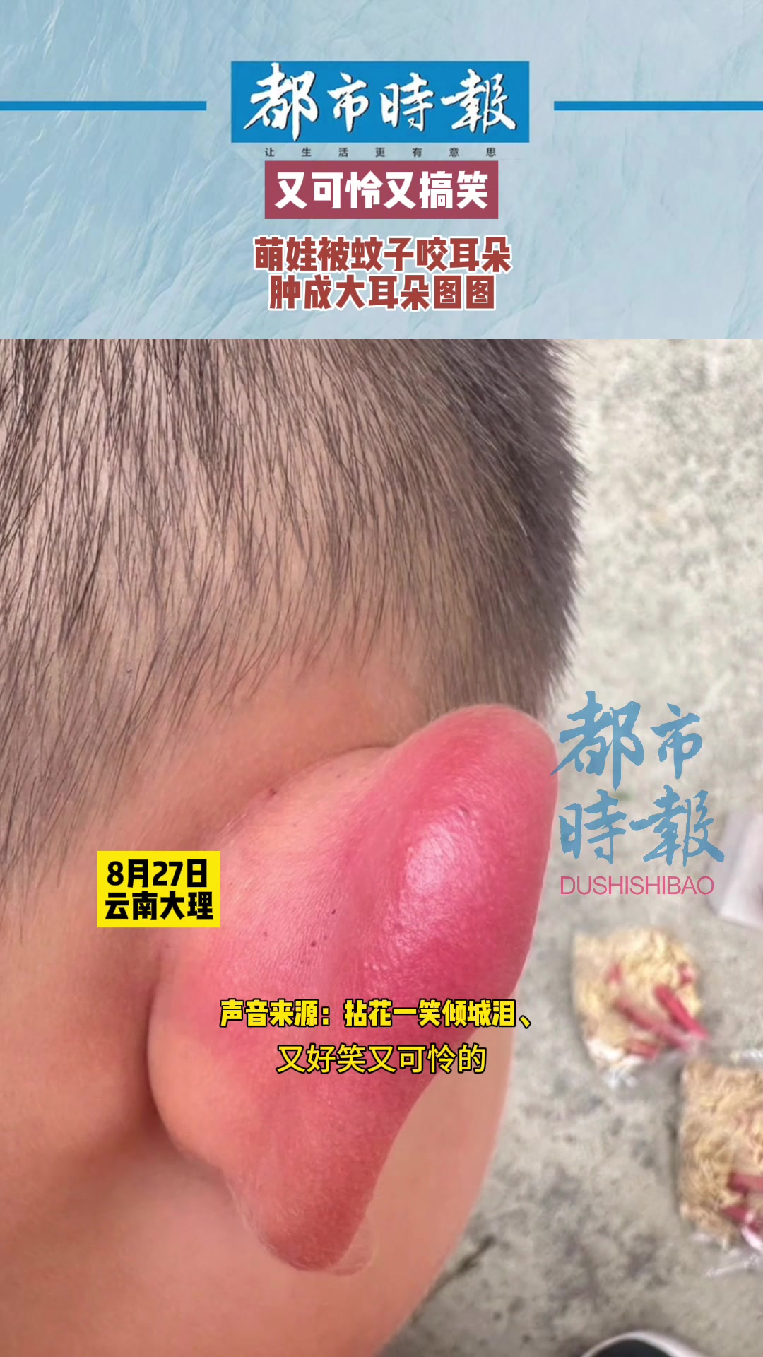 萌娃耳朵被叮咬后，抓成了大耳朵图图