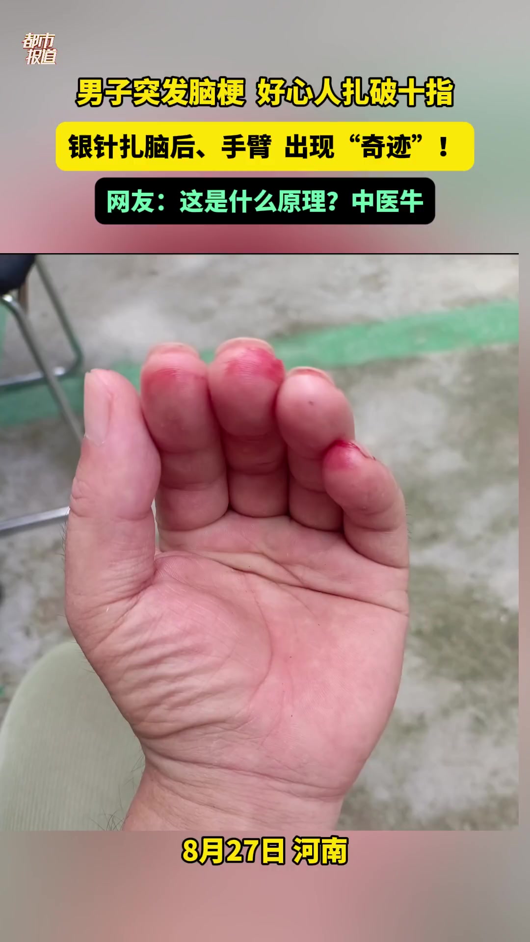 男子突发脑梗，好心人扎破十指救命