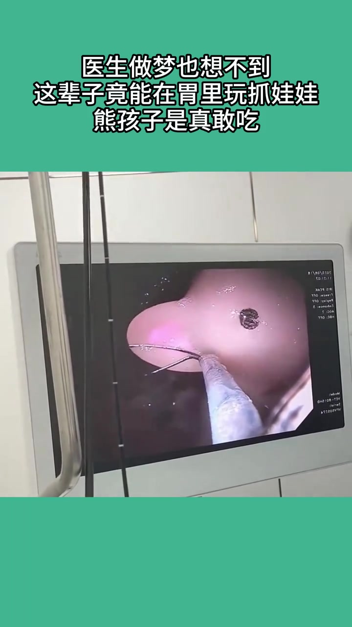 医生估计做梦也想不到，这辈子竟能在胃里抓娃娃！