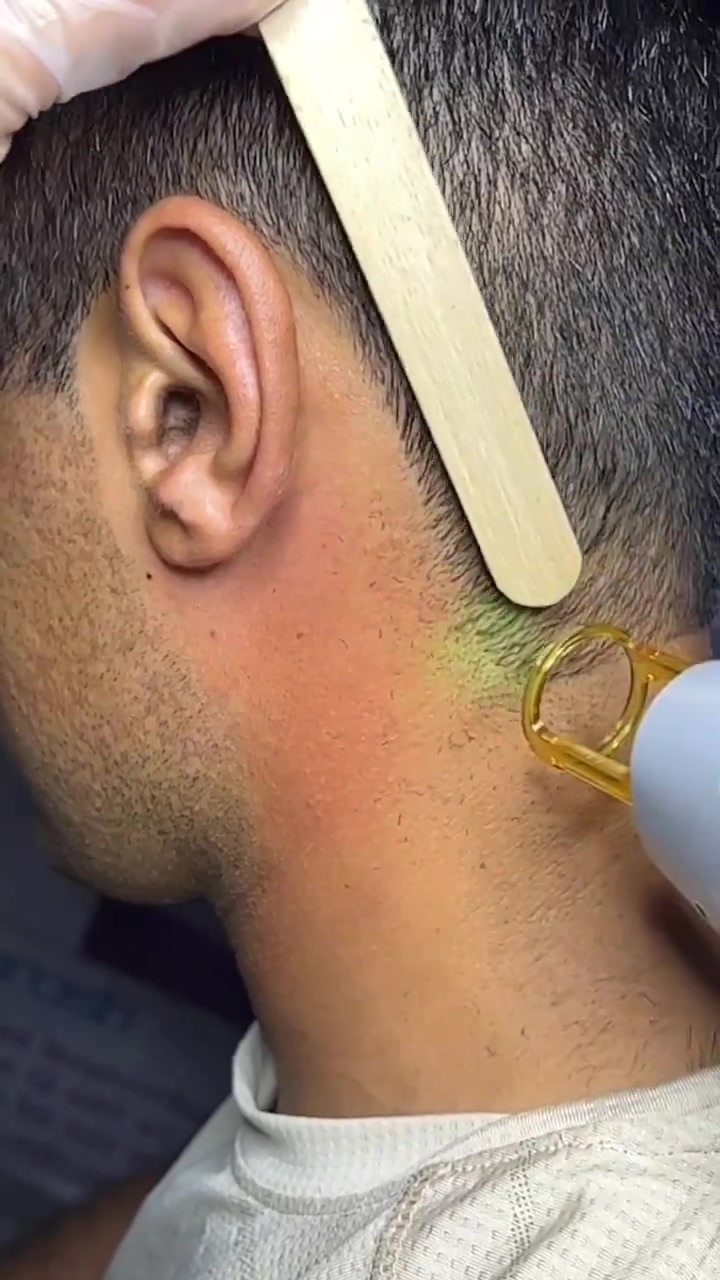 激光理发感觉有点儿费头