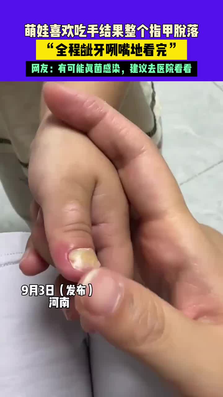 萌娃喜欢吃手结果整个指甲脱落，全程呲牙咧嘴地看完！