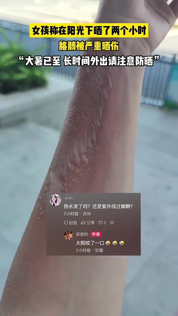 太夸张应该不是太阳！女子称晒了两个小时太阳，胳膊被严重晒伤！