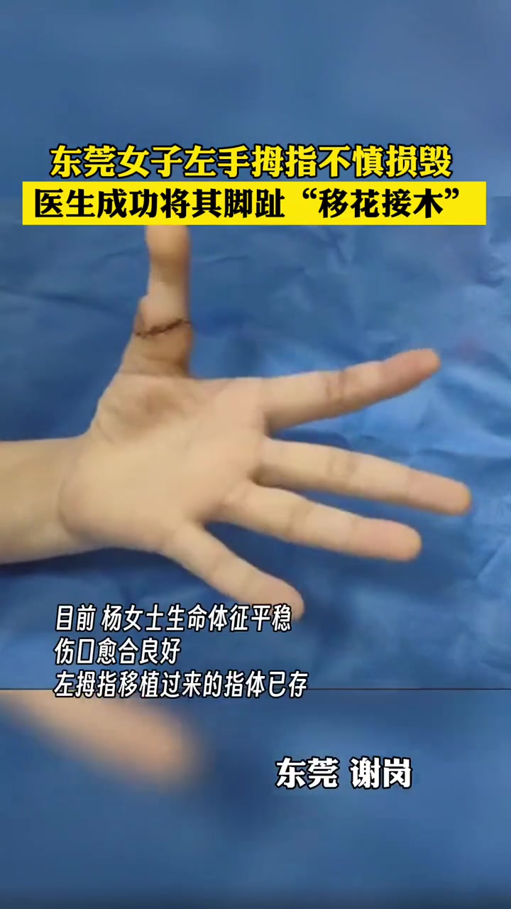 女子左手拇指不慎损毁医生成功将其脚趾“移花接木