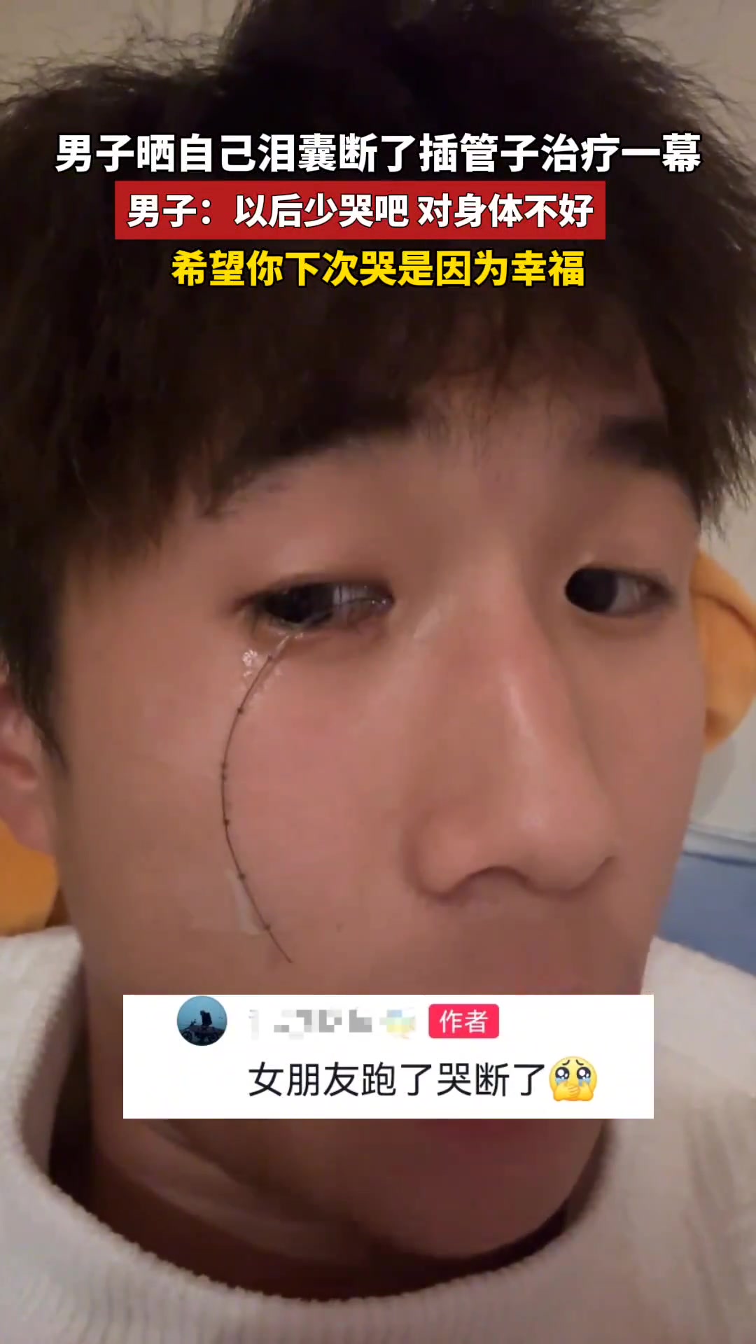 男子晒自己泪腺断了，插管子治疗一幕
