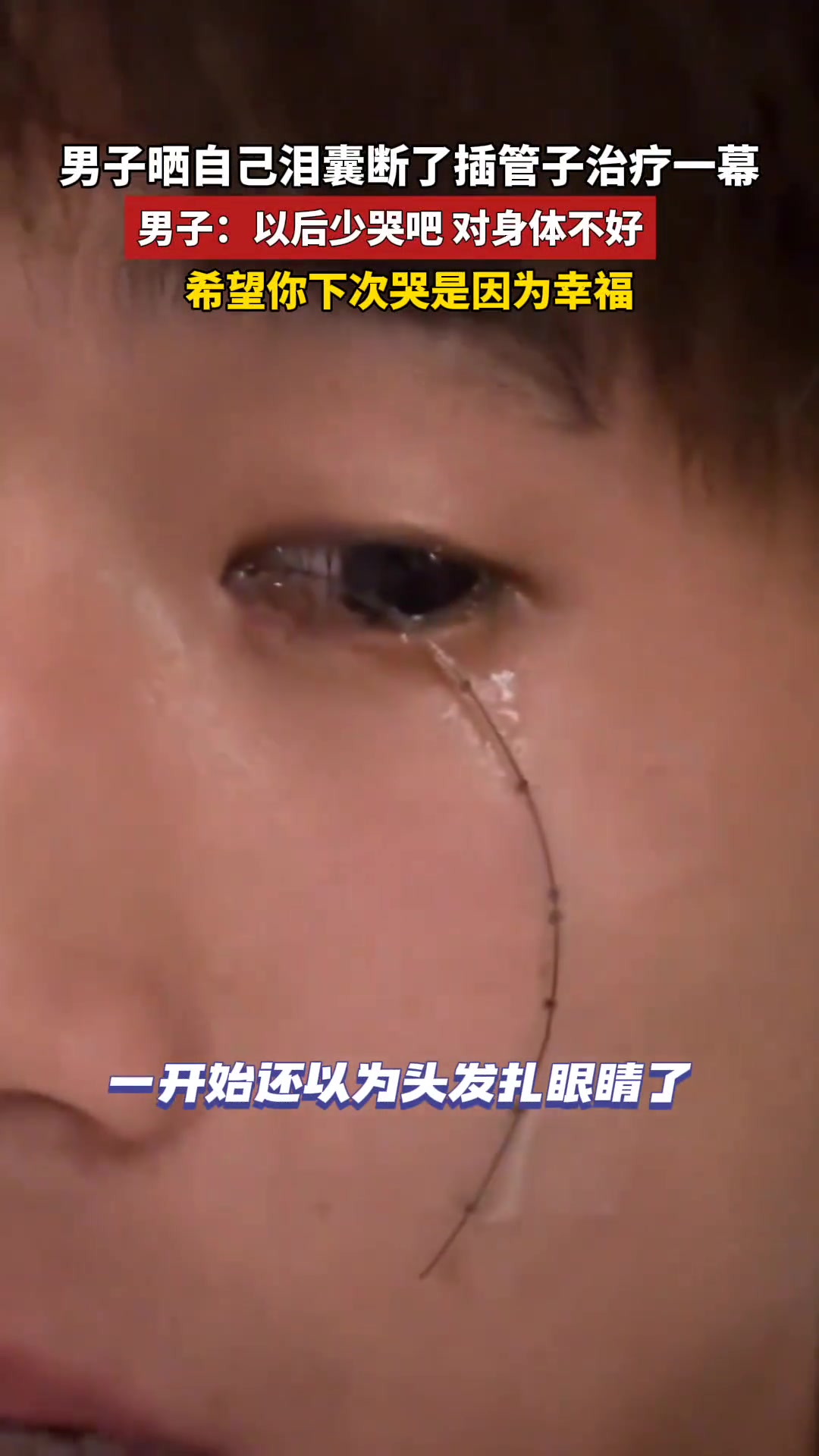 眼睛里插一根头发！原来是插管子啊，那没事了！