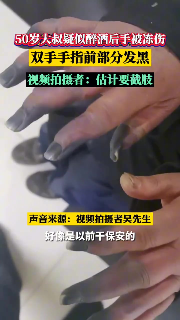 估计要截肢！！大叔手被冻伤，手指发黑！！