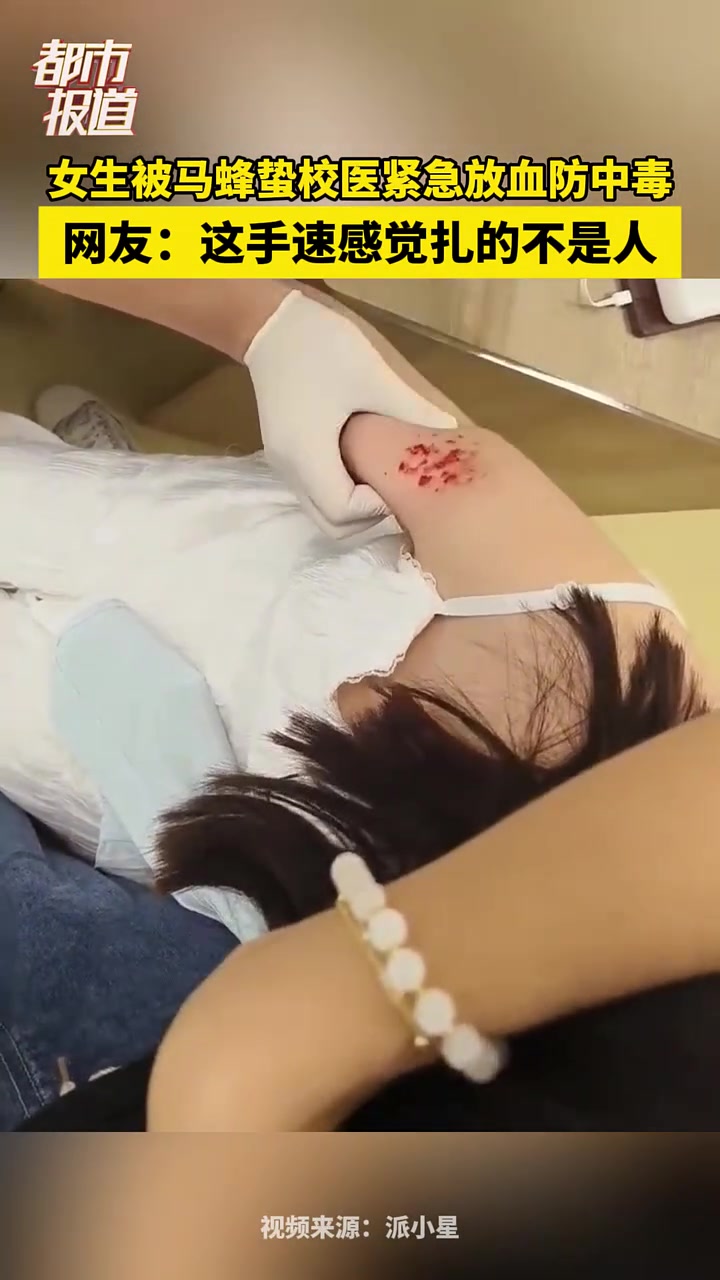 女子被马蜂蛰伤，校医放血防中毒