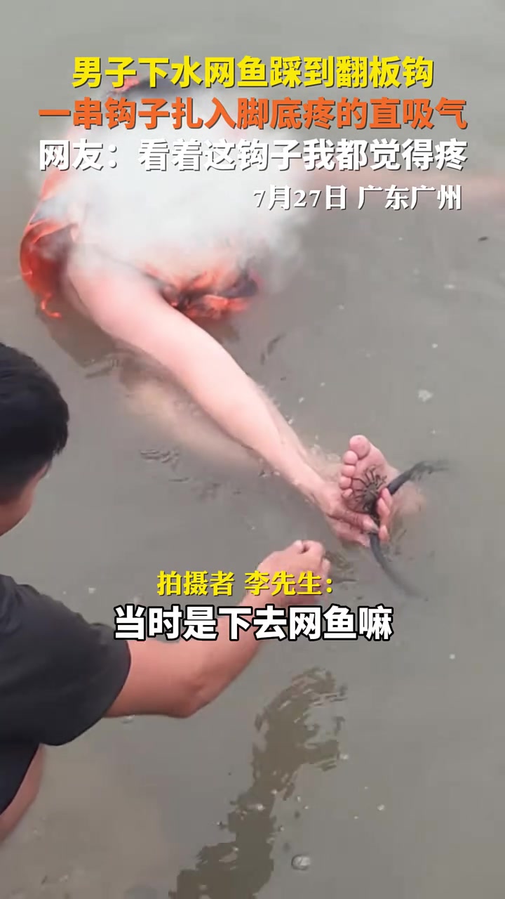 一串鱼钩子扎入脚底！男子下水网鱼踩到翻板钩，疼的直吸气！