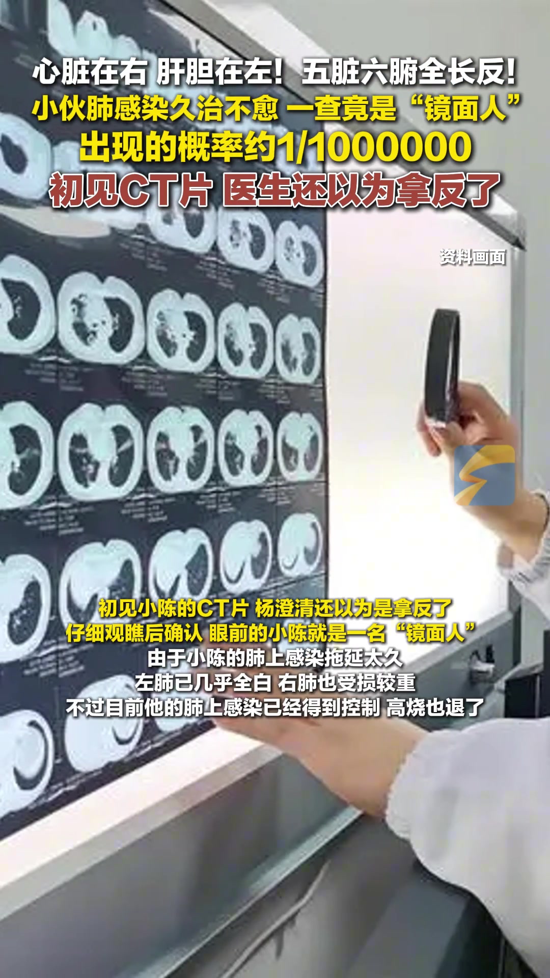 好家伙！心脏在右，肝胆在左！五脏六腑全长反了！