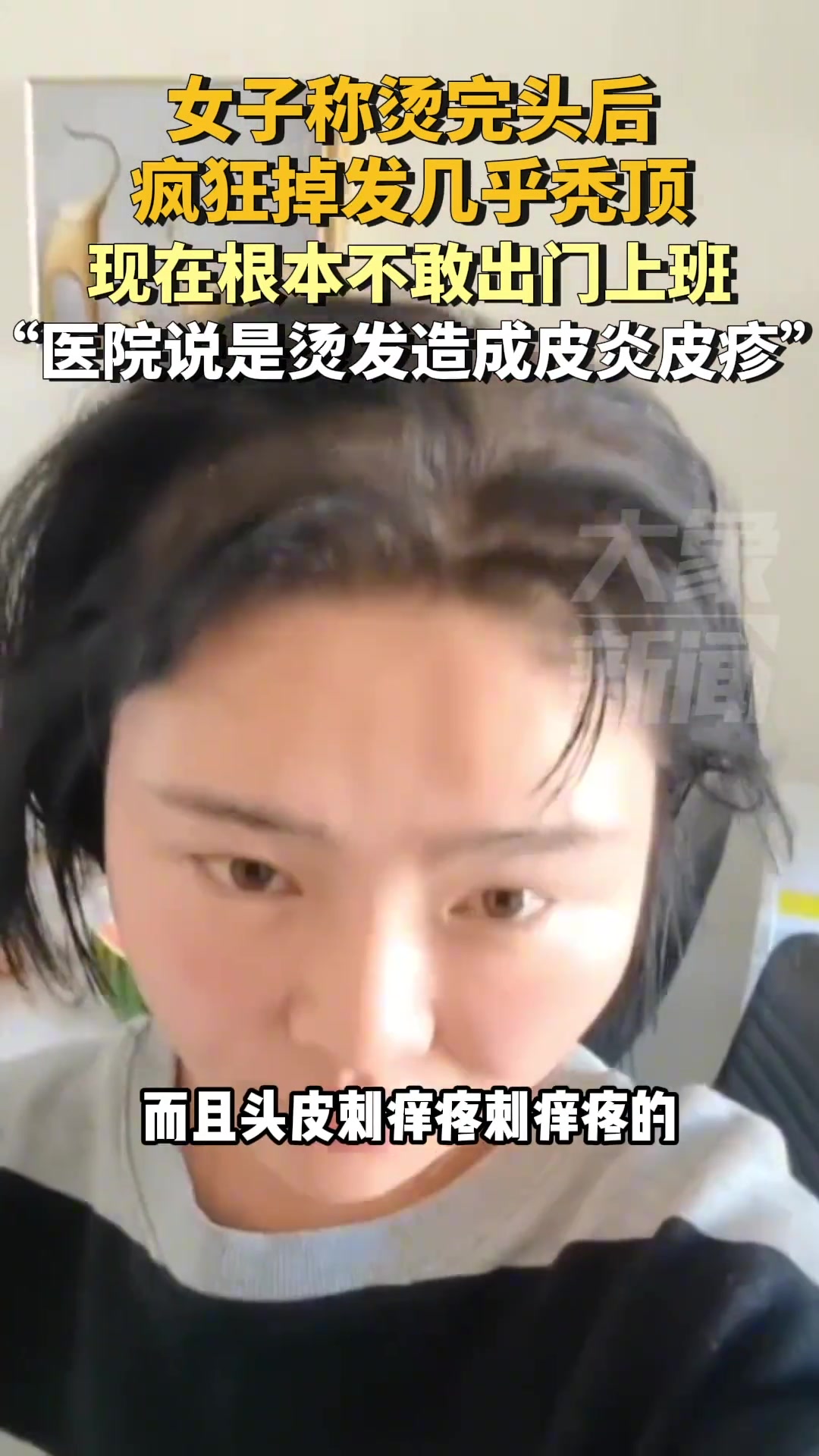 女子称烫完头后疯狂掉发现在几乎秃顶女子：根本不敢出门上班